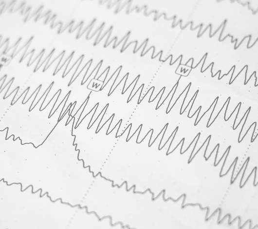 Electromiografia (EMG) de fibra simple o unica