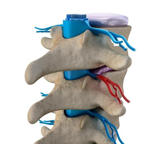 ¿Qué es la mielitis transversa?