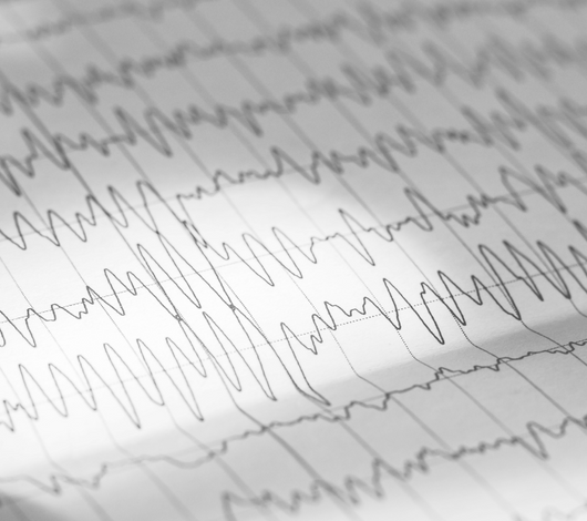 Electromiografia (EMG) de fibra simple o única